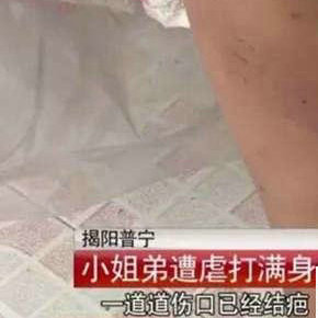 广东揭阳十几岁姐弟被亲爹继母虐打7年体无完肤