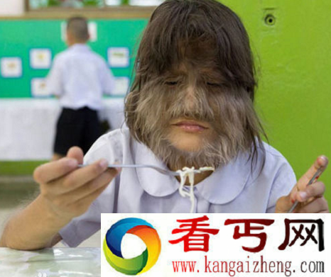 世界上毛发最多的女孩