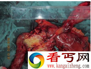 胰十二指肠切除术实际操作图
