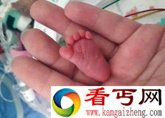 世界上出生最轻的婴儿