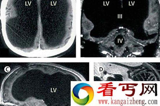 真正的“脑残” 英国男子剩一半大脑仍可生活