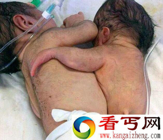 印度一孕妇生下罕见寄生胎 孩子连体一个没有下半身