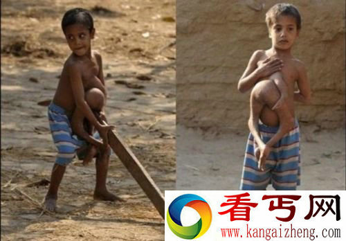 恐怖变异人 男孩腹部长出连体手腿