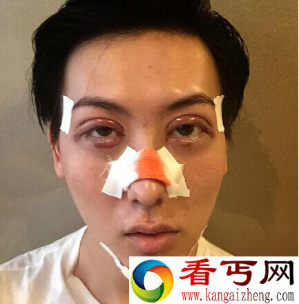 “天然蛇精男”自爆整容照  吓坏网友回呛天然美