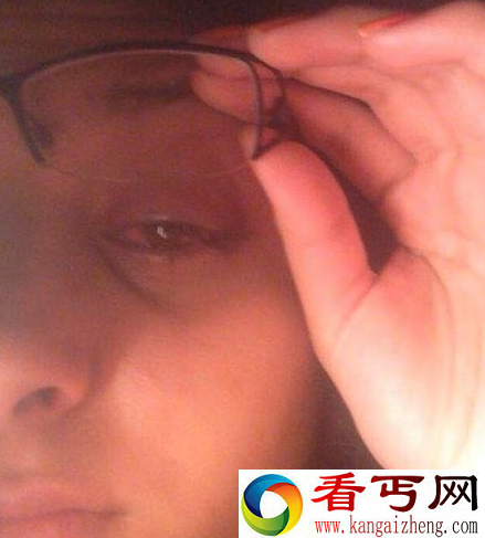 少女眼睛红肿骇人 原来是寄生虫蚕食眼睛