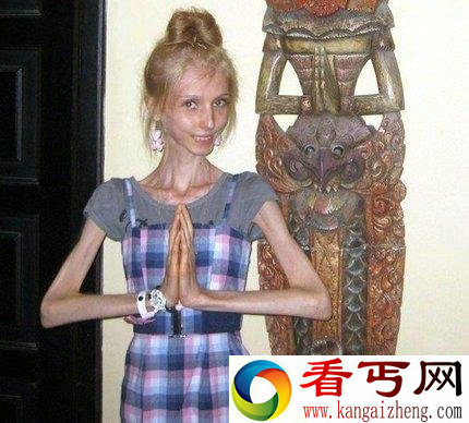 失误！美国一美女减肥过度竟成干尸