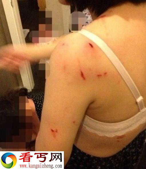 恐怖现场:美女洗澡时玻璃门爆裂 左胸大面积扎伤