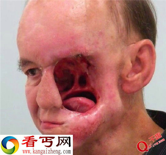 恐怖慎入!恶性肿瘤吃了他半个脸蛋