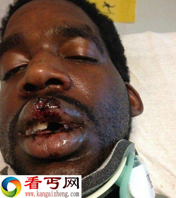 恐怖!电子烟在男子嘴中爆炸了