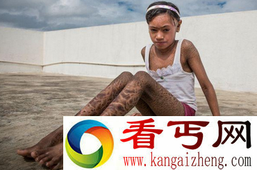 13岁印度少女全身如蛇皮 被视其为妖怪