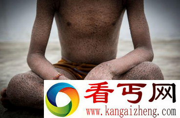 13岁印度少女全身如蛇皮 被视其为妖怪