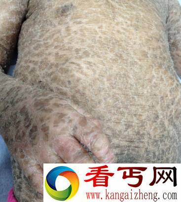 13岁印度少女全身如蛇皮 被视其为妖怪