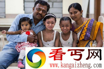 13岁印度少女全身如蛇皮 被视其为妖怪