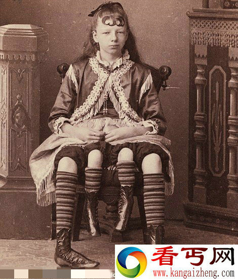 美国两百年前怪异畸形秀  长四条腿女孩狗脸男孩