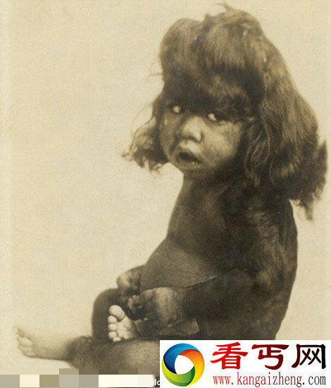 美国两百年前怪异畸形秀  长四条腿女孩狗脸男孩
