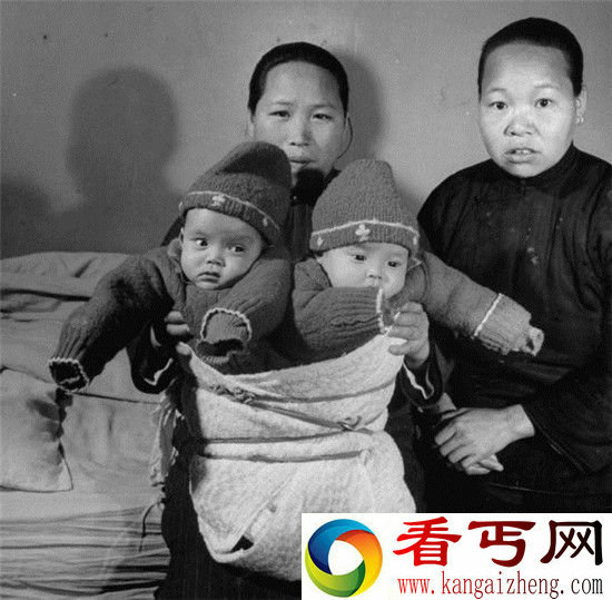 上海1947年连体婴 竟然被如此处理