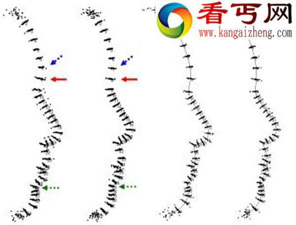 中国人面部几何形态初探 侧面轮廓形状及其变异