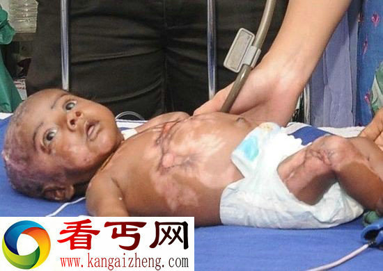 【环球网综合报道】英国每日邮报13日报道，印度一名3个月大的男婴在出生后身体已经4次起火，医生怀疑自燃是其汗液造成的，目前相应检测正在进行中。